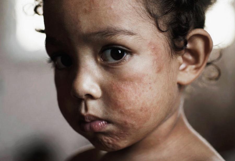 CDC-Minsa, notificaci&oacute;n y sarampi&oacute;n